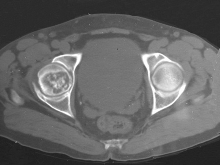 Condrosarcoma de la Cabeza Femoral