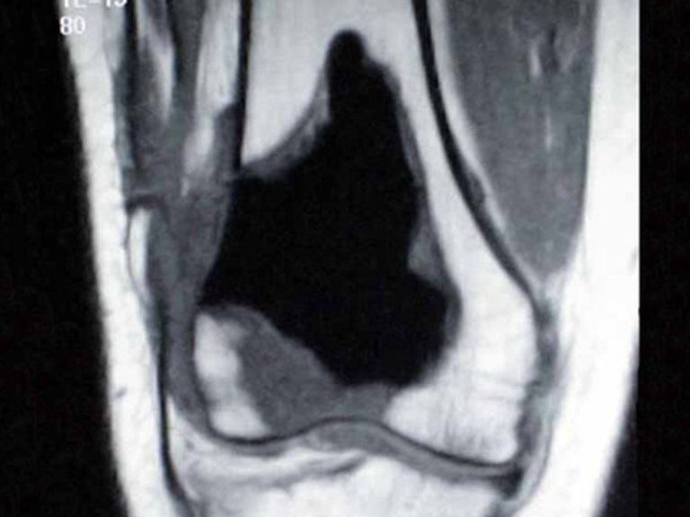 Condrosarcoma del Fémur