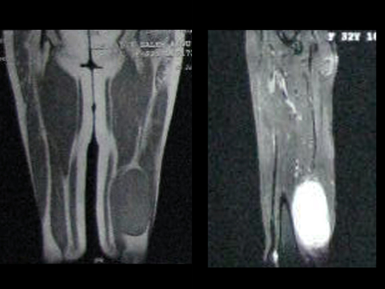 Sarcoma de la Región Poplítea