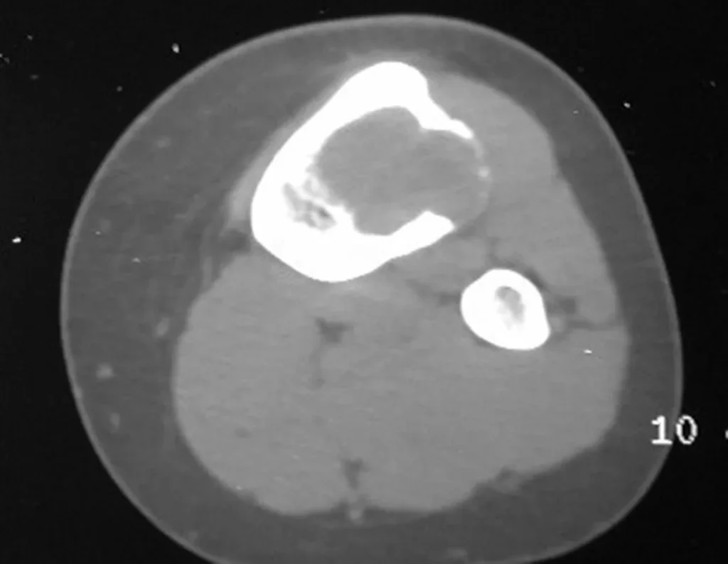 Figura Figura 56 – A tomografia revela área radiolucente; erosão óssea; afilamento da cortical e insuflação. sem focos de calcificação.