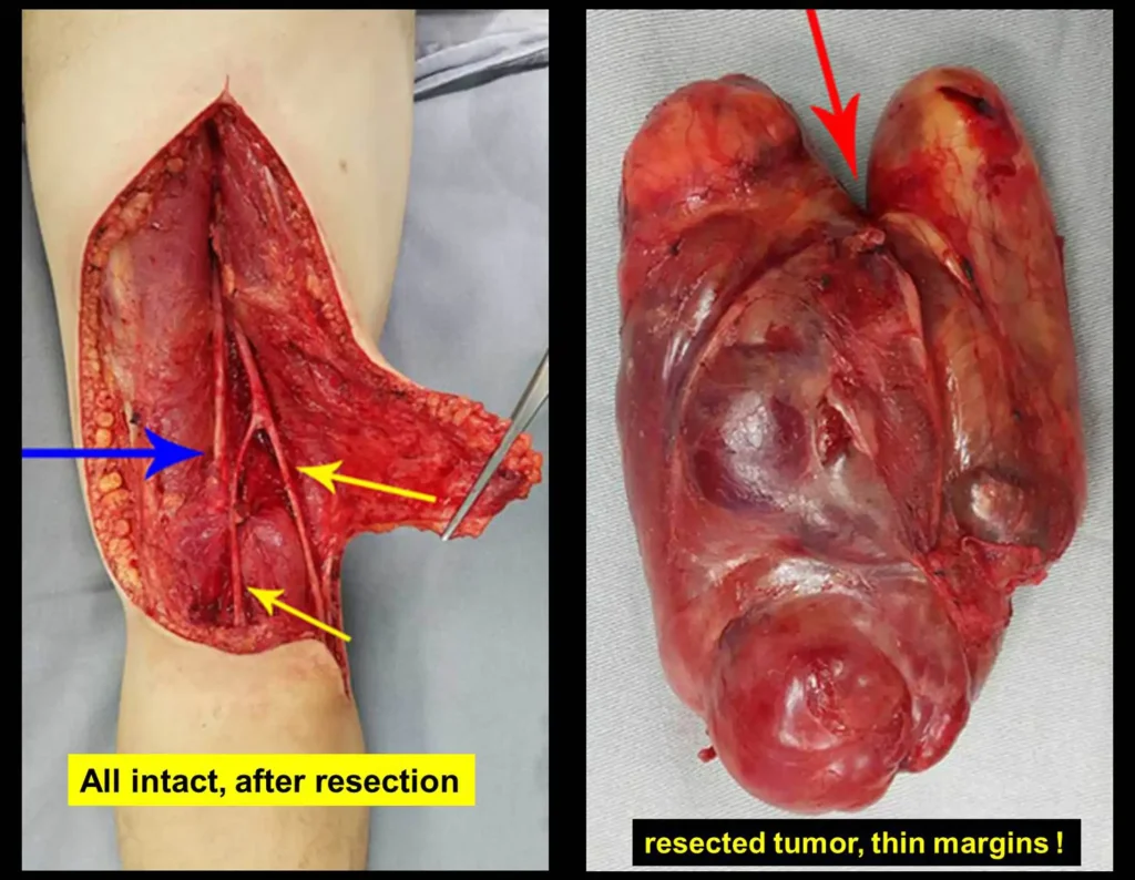 Figura 10: Cirurgia oncológica com total preservação da função. Tumor ressecado com margens exíguas. Realizamos radioterapia adjuvante.