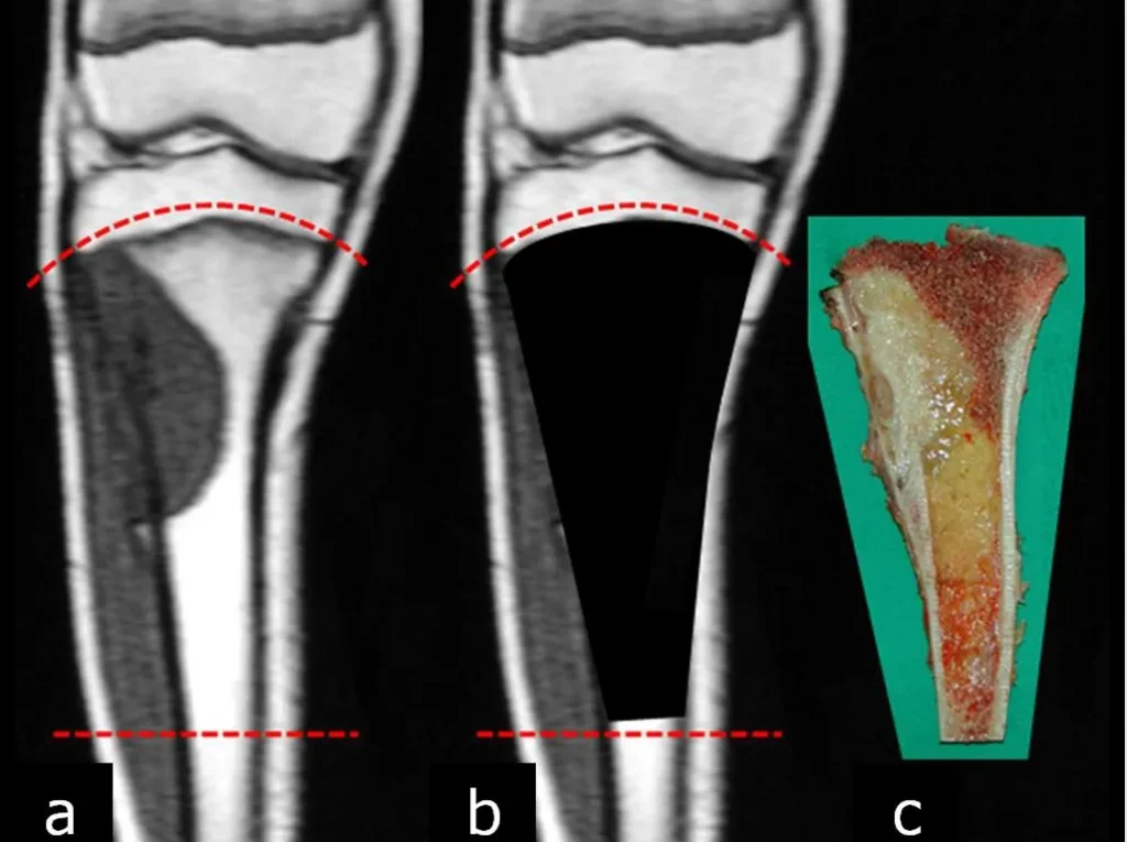 Figura 1: a- Região proximal da tíbia comprometida pelo tumor, b- esquema da falha a ser reconstruida e c- o segmento ressecado