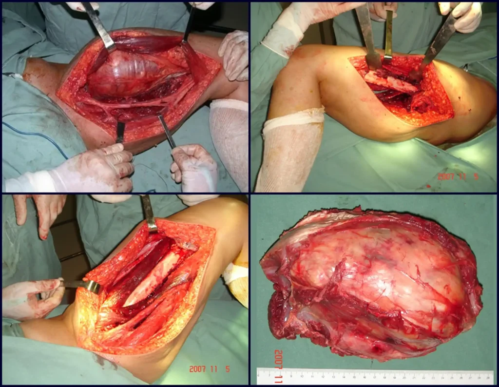 Figura 4: Para uma adequada ressecção com segurança realizamos dois acessos cirúrgicos. Primeiramente o acesso medial da coxa, para isolamento do feixe femoral vascular e nervoso e descolamento periosteal medial, complementando com a via lateral, para a dissecção e descolamento periosteal lateral e anterior.