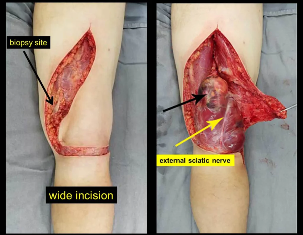 Figura 8: Incisão ampla póstero medial e curvando-se sobre a prega poplítea, com exérese do trajeto da biópsia. Operamos sem garrotear o membro, realizando cuidadosa hemostasia e expondo os ramos do nervo ciático deslocados pelo tumor.