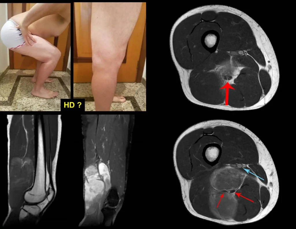 Figura 5: Tumor do cavo poplíteo, de evolução rápida, com íntima relação com o feixe vascular, envolvendo, dividindo e afastando os ramos do nervo ciático. Qual será o diagnóstico?