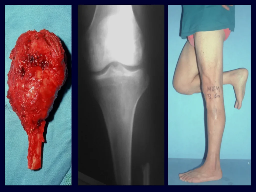 Peça ressecada; radiografia pós operatória e paciente com carga monopodal, boa função sem instabilidade.