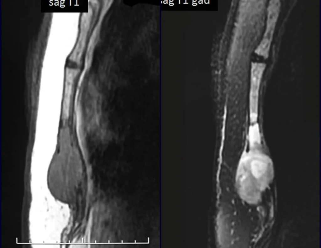 Figura 16: a- Ressonância magnética sagital T1, evidenciando a erosão e abaulamento da região. b- Ressonância magnética sagital T1 com contraste mostrando uma lesão heterogenia de alto e baixo sinal.