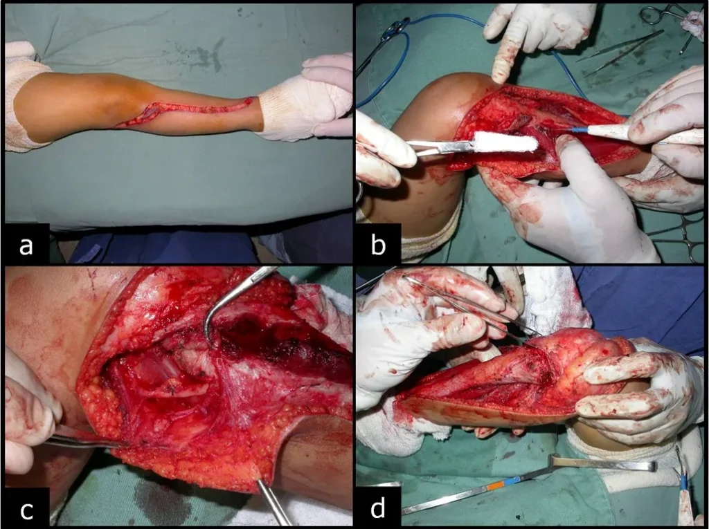 Figura 2: a- Via de acesso única, b- abertura do perimisio e lateralização do músculo tibial anterior, c- dissecção da porção proximal da fíbula e d- isolamento da epífise tibial.