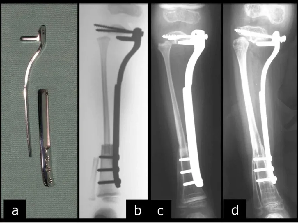 Figura 7: a- placa proximal com suporte horizontal, para apoio do planalto da tíbia, b- radiografia do pós operatório imediato, c- radiografia com 3 meses, mostrando a consolidação tibio-fibular e d- radiografia com 6 meses, evidenciando a hipertrofia da fíbula.