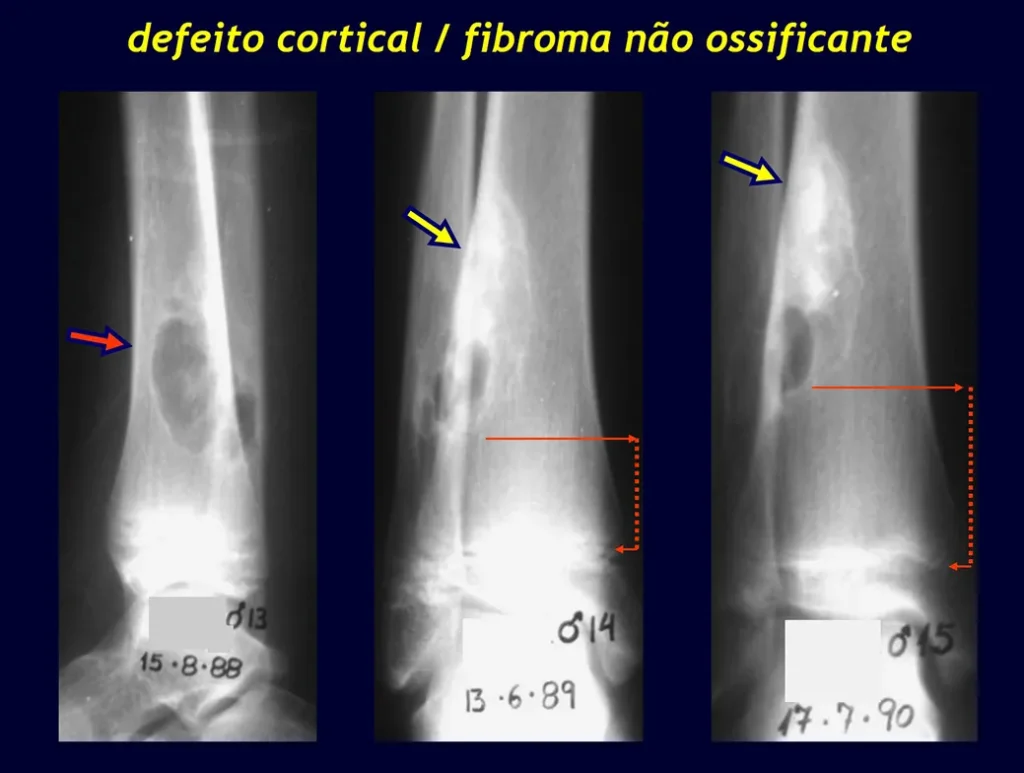 Fibroma não ossificante, acompanhado clinicamente, sem intervenção.