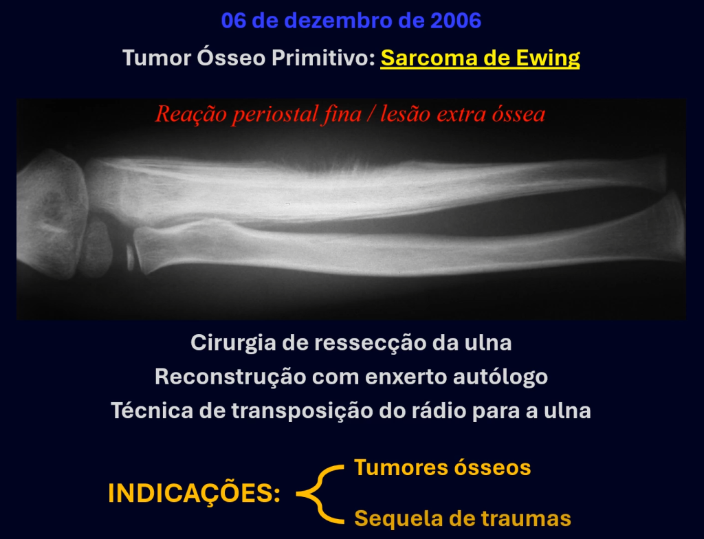 Tumor Ósseo Primitivo: Sarcoma de Ewing