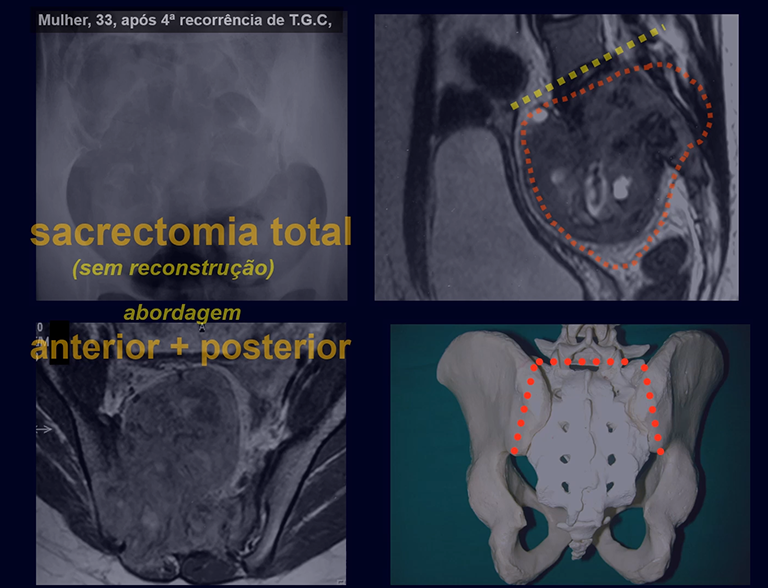 Sacrectomia total sem reconstrução - Parte 1