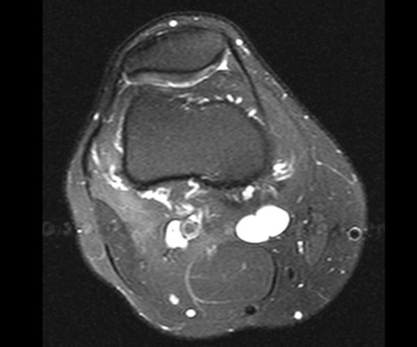 Figura 1: Ressonância magnética realizada um ano antes da queixa atual. Imagem axial ponderada em T1, com supressão de gordura, evidenciando lesão cística na região posterior do joelho direito.