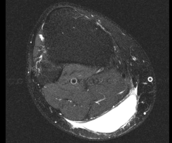 Figura 10: Ressonância magnética atual evidenciando imagem axial ponderada em T1, com supressão de gordura, com lesão de alto sinal, entre o plano celular subcutâneo e a fáscia muscular.